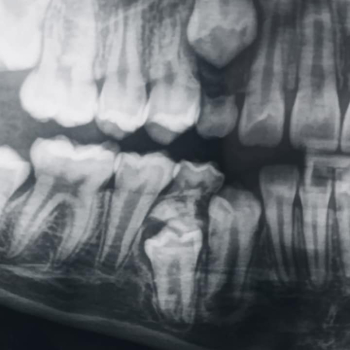 Casos Clínicos odontomas